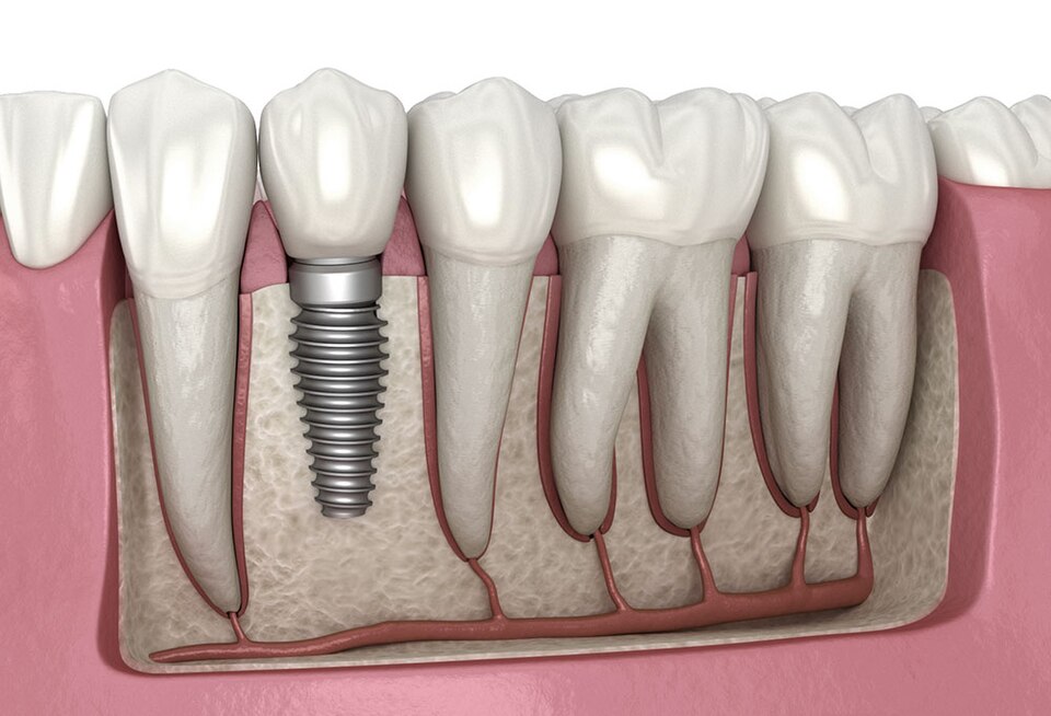 Implant Dentar